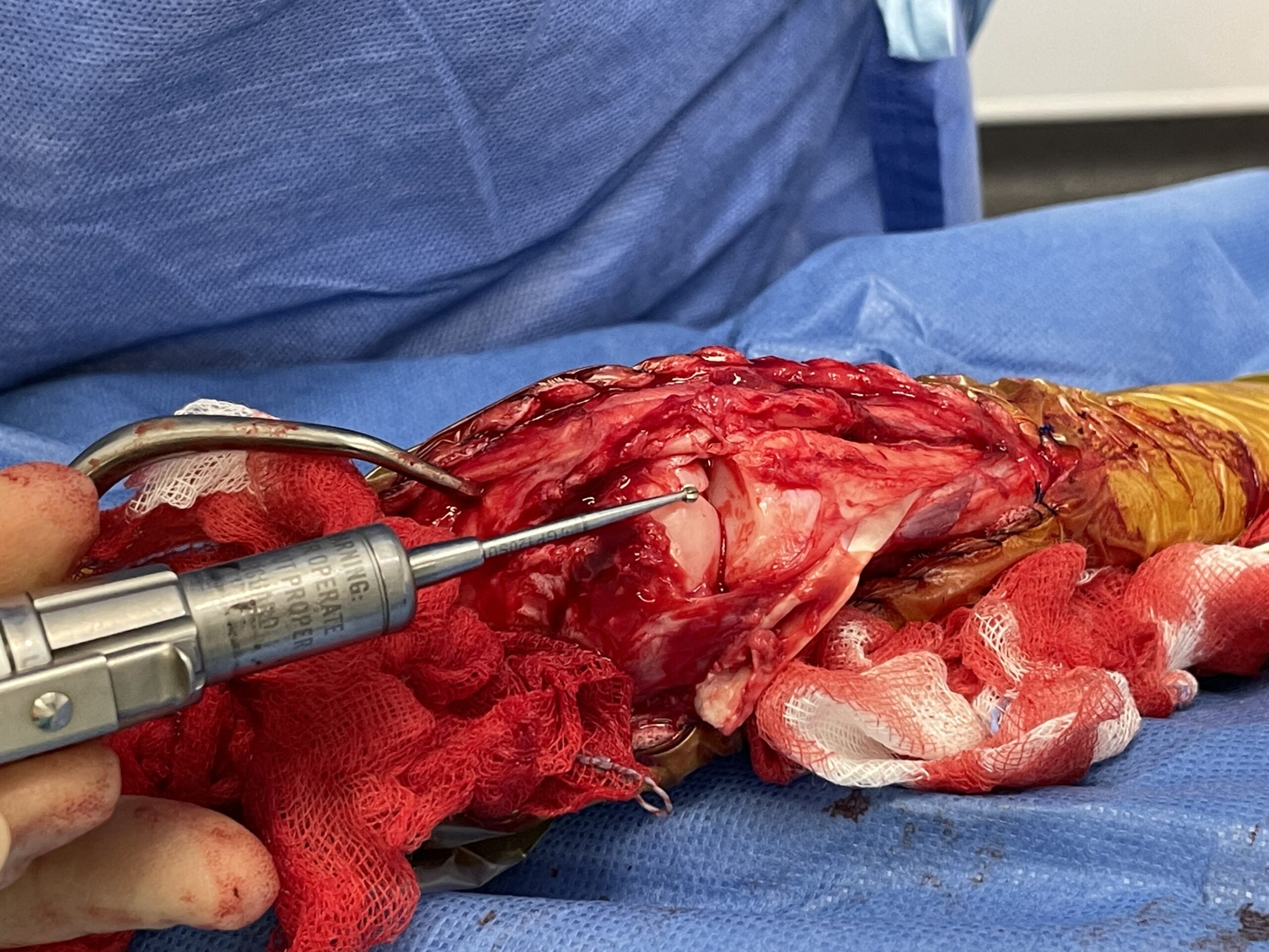 Arthrodesis burring cartilage