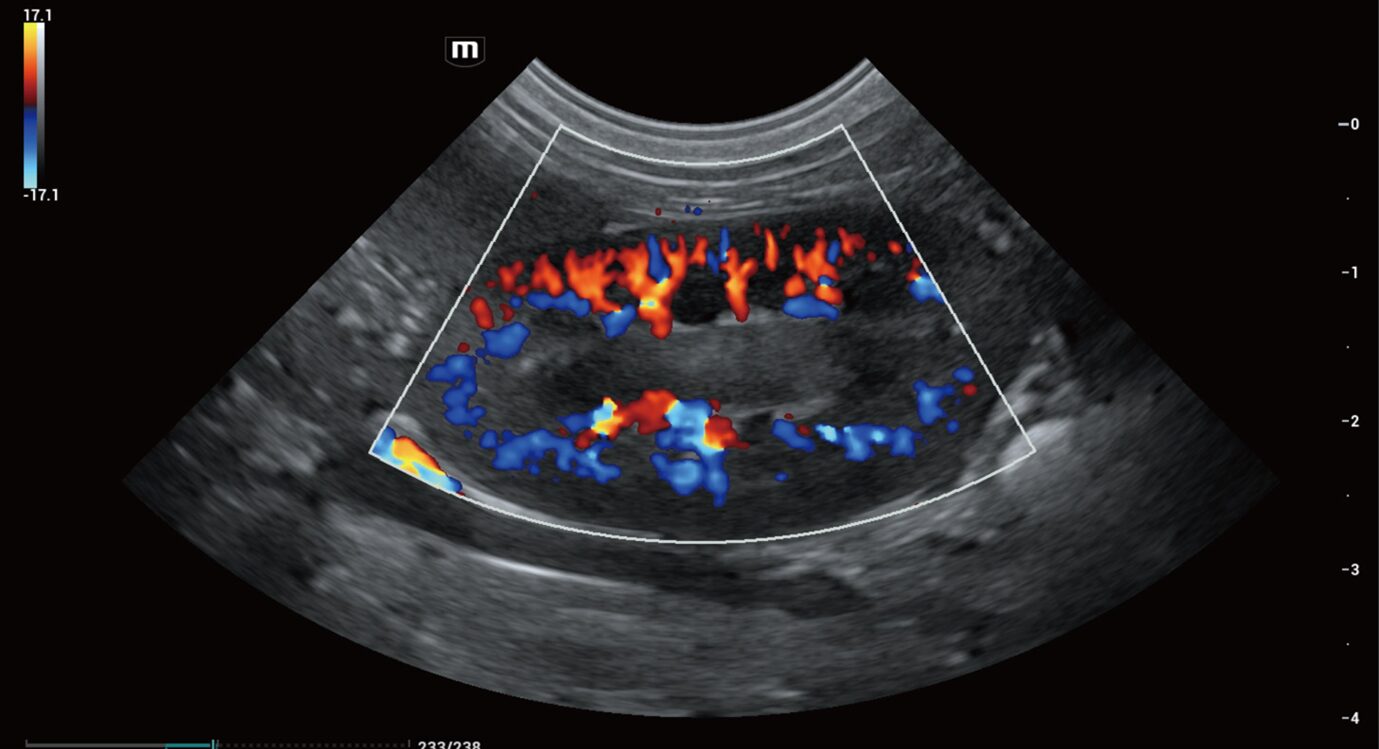 Colour doppler interrogation of the renal vasculature
