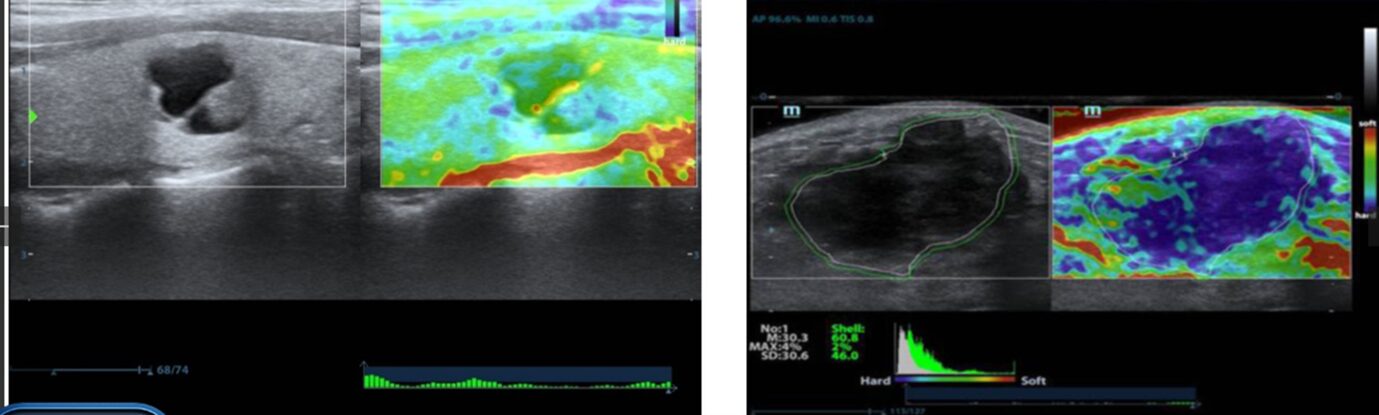 Splenic elastography used to aid clinical decision making #1